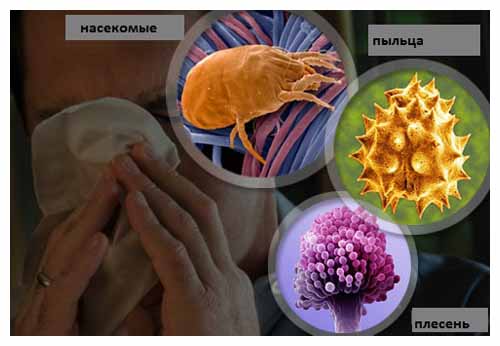 аллергический ринит