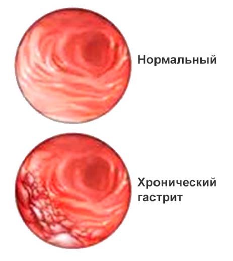 хронический гастрит хронический гастрит