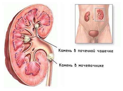 камни в почках камни в почках